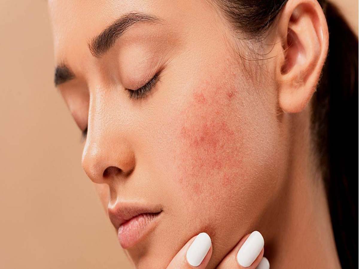 Apart from dust and pollution, these foods can also cause acne, do not include them in your diet